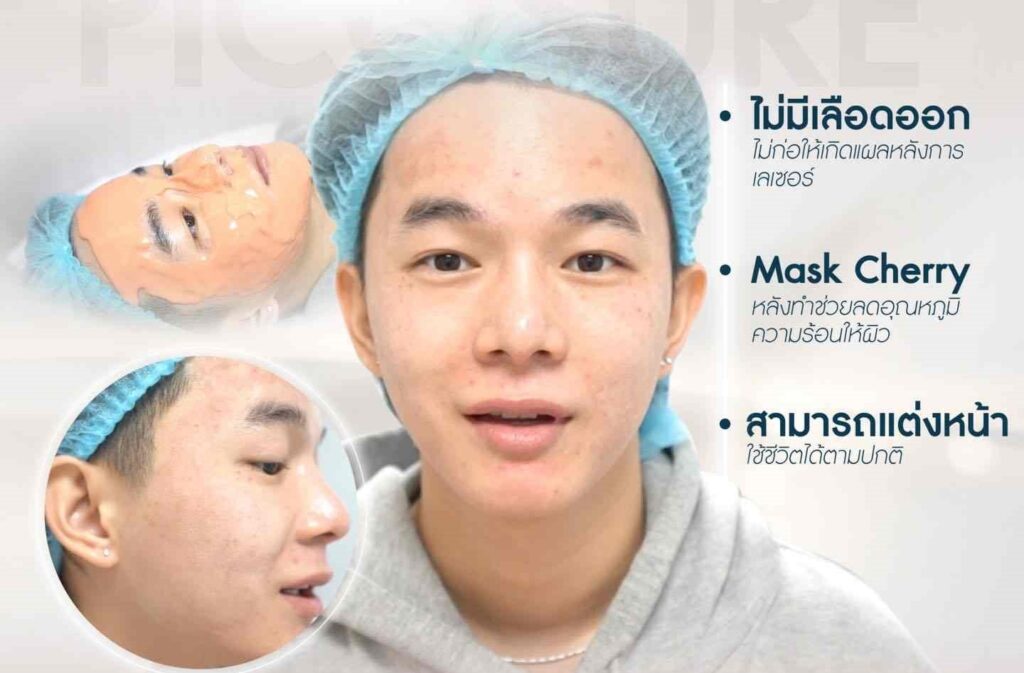 PicoSure ดีจริงไหม PicoSure คืออะไร ทำไมถึงน่าสนใจ